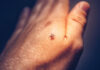 Tick-Borne Illnesses on the Rise